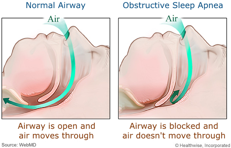 what is sleep apnea